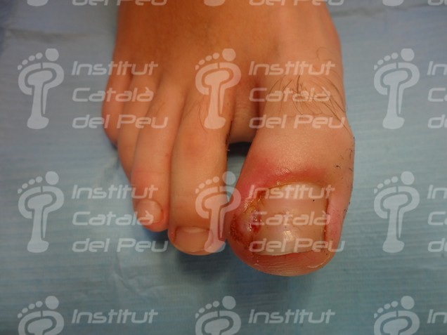 THE ONYCHOCRYPTOSIS OR INGROWN NAIL