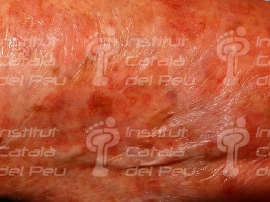 THE ACTINIC KERATOSIS. THE MOST FREQUENT PRE-CANCER OF SKIN.