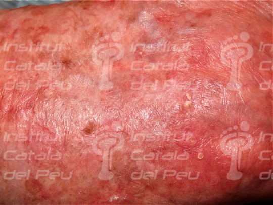 THE ACTINIC KERATOSIS. THE MOST FREQUENT PRE-CANCER OF SKIN.