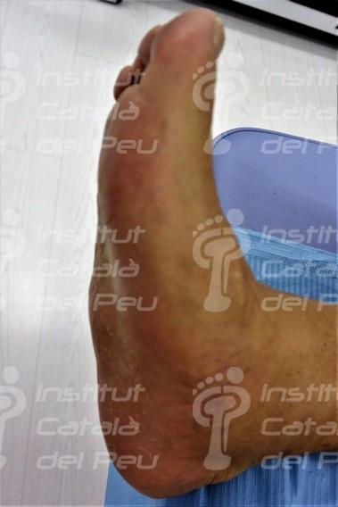 THE NEUROPATHIC ARTHROPATHY OR CHARCOT’S FOOT.