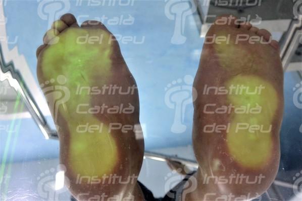 THE NEUROPATHIC ARTHROPATHY OR CHARCOT’S FOOT.