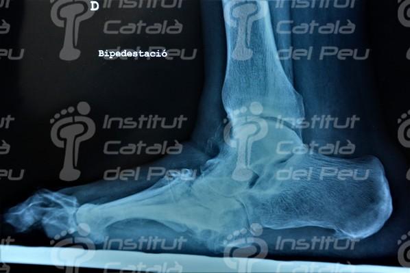 THE NEUROPATHIC ARTHROPATHY OR CHARCOT’S FOOT.