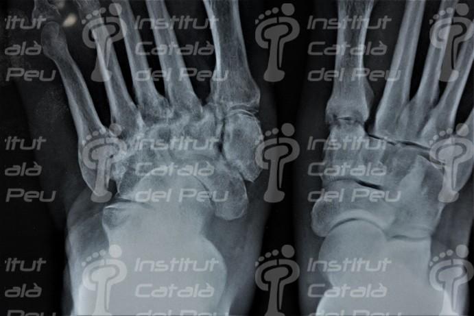La artropatía neuropática o pie de Charcot.