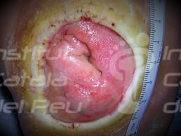 THE NEUROPATHIC ARTHROPATHY OR CHARCOT’S FOOT.