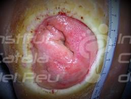 La artropatía neuropática o pie de Charcot.