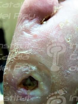 THE NEUROPATHIC ARTHROPATHY OR CHARCOT’S FOOT.