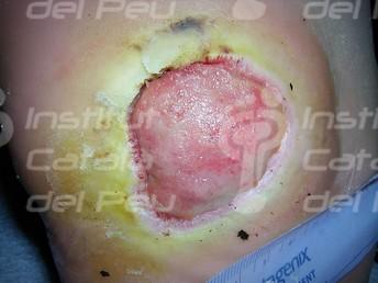 THE NEUROPATHIC ARTHROPATHY OR CHARCOT’S FOOT.