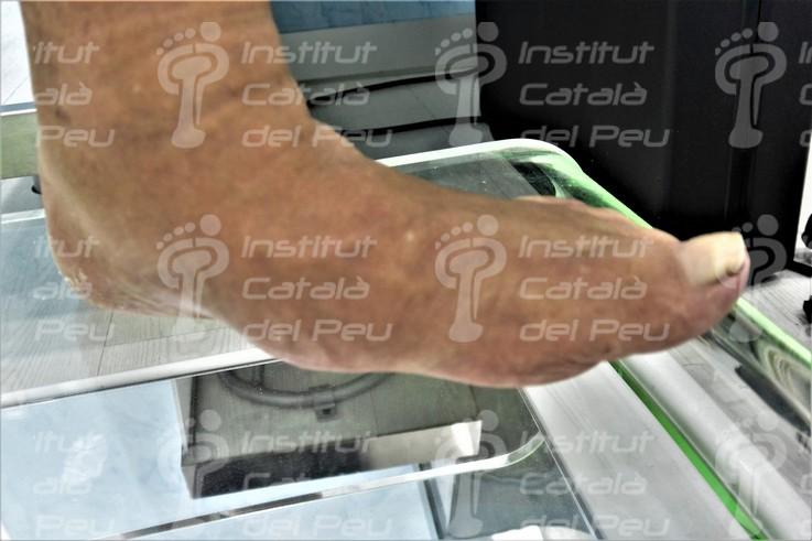 L’artropatia neuropàtica o peu de Charcot