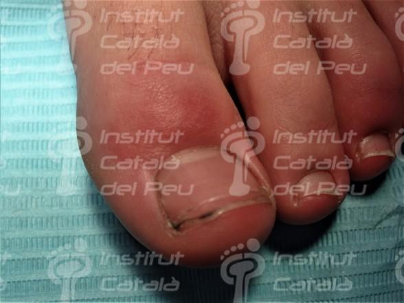 THE CHILBLAINS OR THE ERYTHEMA PERNIO