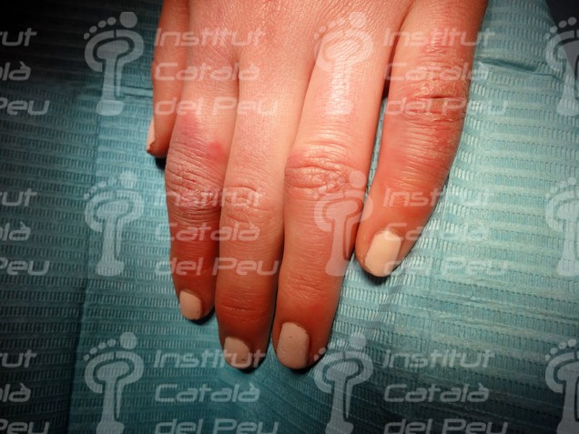 THE CHILBLAINS OR THE ERYTHEMA PERNIO