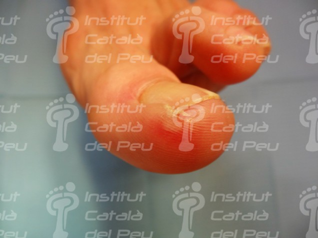 THE CHILBLAINS OR THE ERYTHEMA PERNIO