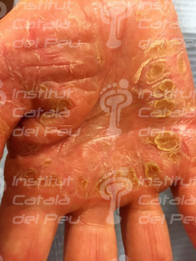 PALMOPLANTAR KERATODERMA. CLASSIFICATION AND TREATMENTS.