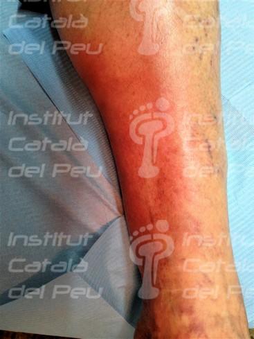 La celulitis: Causas, síntomas y tratamiento. La celulitis: Causas, síntomas y tratamiento.