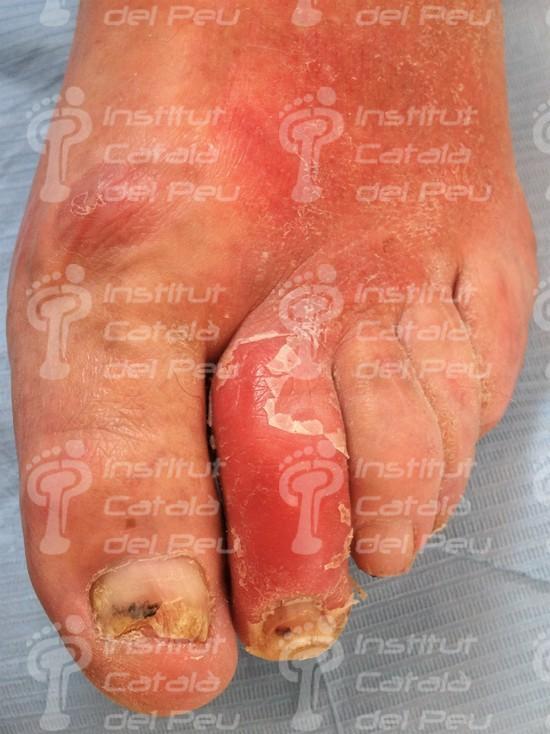 La celulitis: Causas, síntomas y tratamiento. La celulitis: Causas, síntomas y tratamiento.