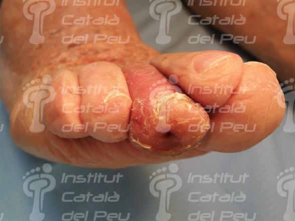 Que Es Una Celulitis En El Dedo Que Es Una Celulitis En El Dedo