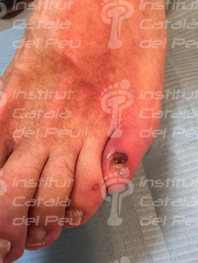La celulitis: Causas, síntomas y tratamiento. La celulitis: Causas, síntomas y tratamiento.
