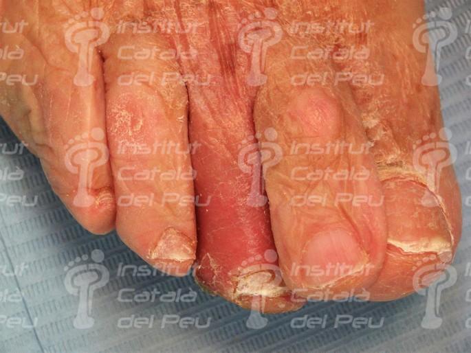 La celulitis: Causas, síntomas y tratamiento. La celulitis: Causas, síntomas y tratamiento.