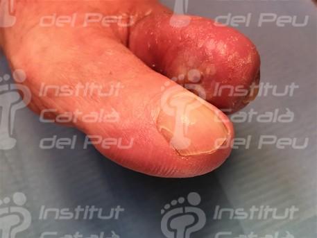 Que Es Una Celulitis En El Dedo Que Es Una Celulitis En El Dedo