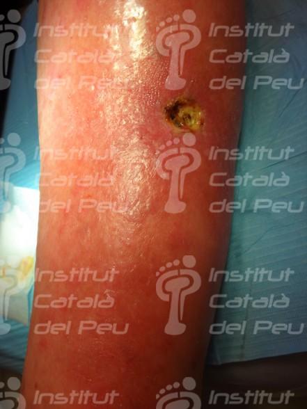 La celulitis: Causas, síntomas y tratamiento.