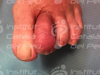 La celulitis: Causas, síntomas y tratamiento. La celulitis: Causas, síntomas y tratamiento.