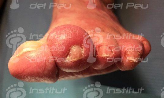 Discusión Que Es Celulitis En Los Pies más Discusión Que Es Celulitis En Los Pies más