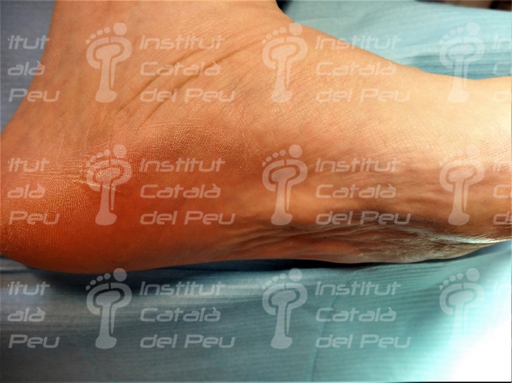 La Enfermedad de Ledderhose o Fibromatosis plantar