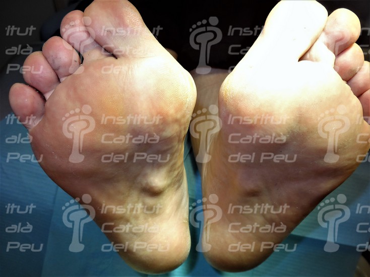 LEDDERHOSE’S DISEASE OR PLANTAR FIBROMATOSIS.