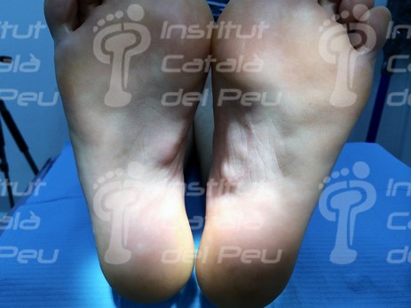 LEDDERHOSE’S DISEASE OR PLANTAR FIBROMATOSIS.