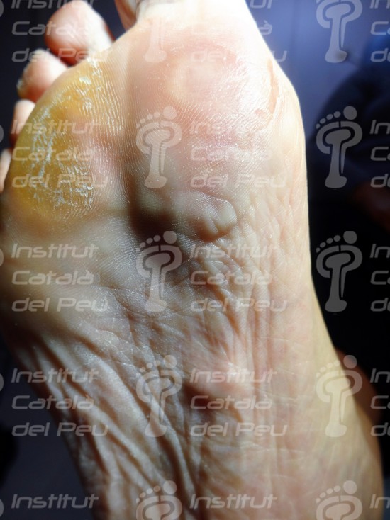 La Enfermedad de Ledderhose o Fibromatosis plantar