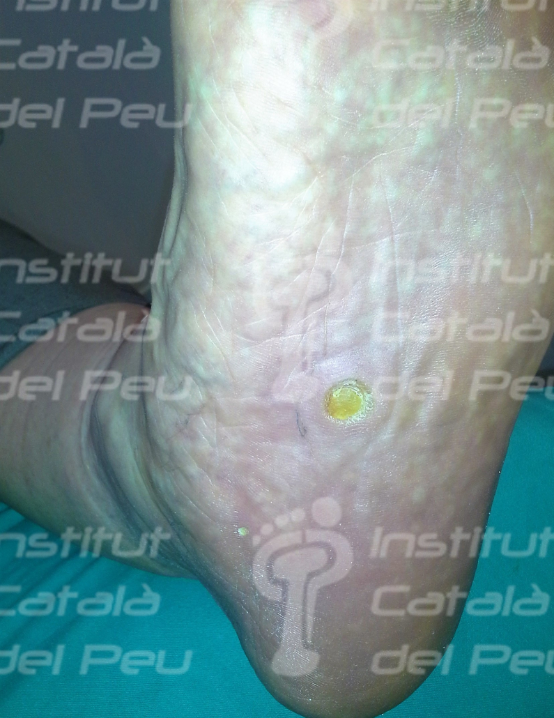 HELOMA BY INCLUSION. CONCEPT, DETECTION AND TREATMENT.