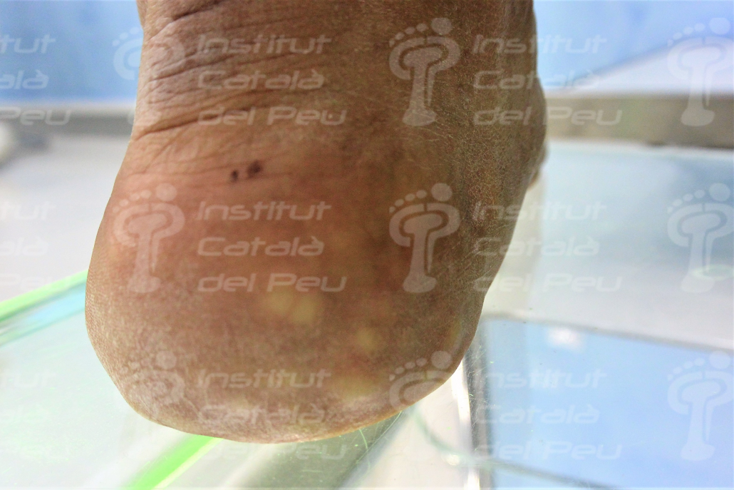 PIEZOGENIC PAPULES. GENERAL CONCEPTS. PIEZOGENIC PAPULES. GENERAL CONCEPTS.