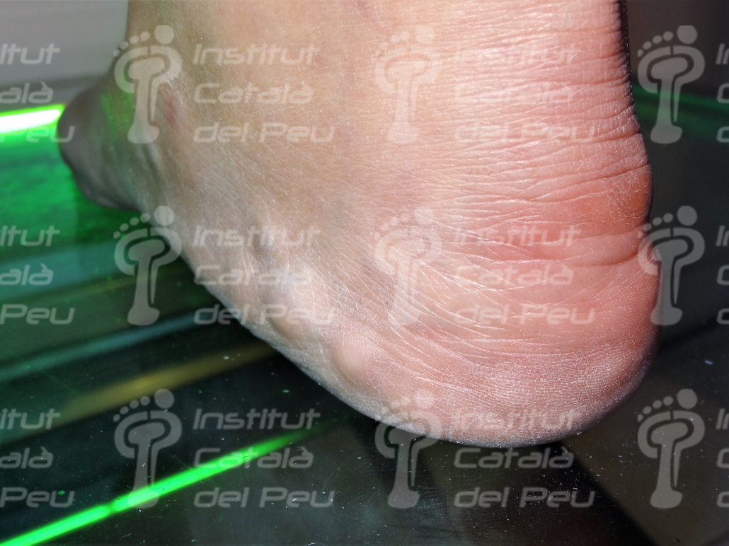 PIEZOGENIC PAPULES. GENERAL CONCEPTS. PIEZOGENIC PAPULES. GENERAL CONCEPTS.