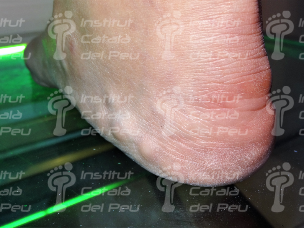 PIEZOGENIC PAPULES. GENERAL CONCEPTS.