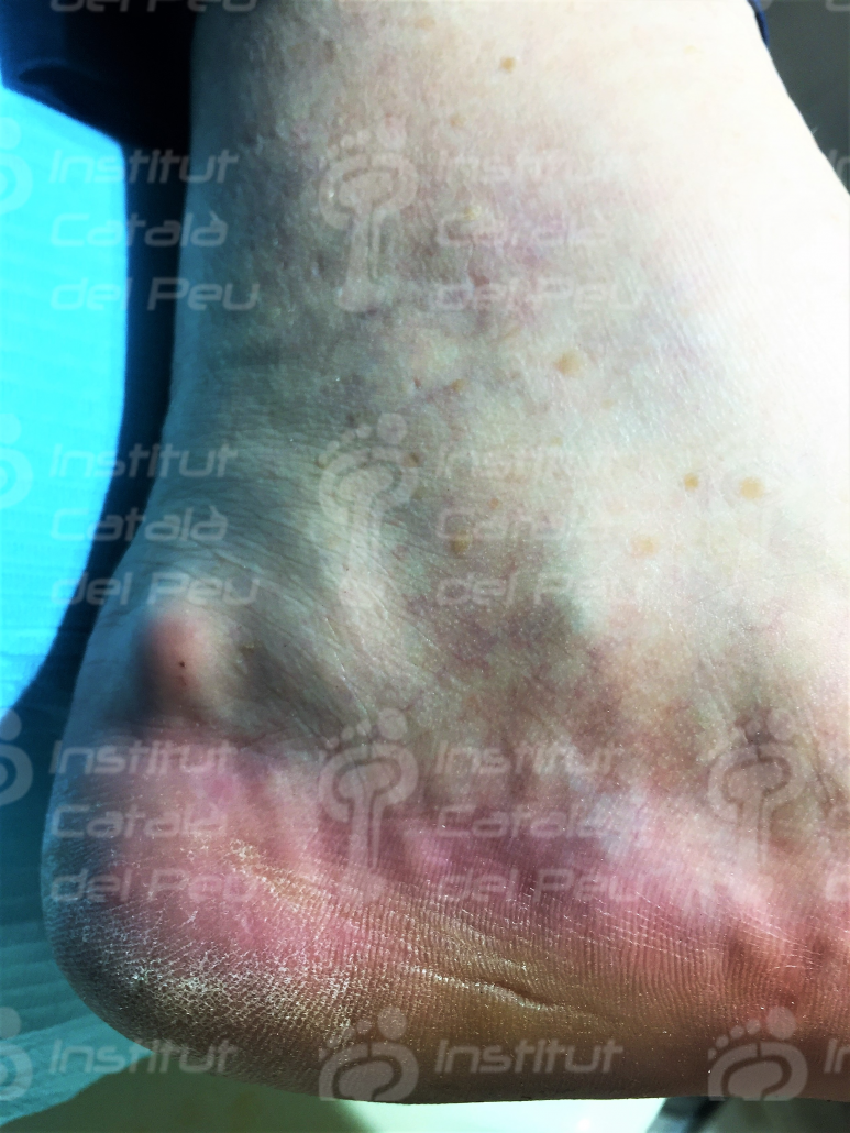 PIEZOGENIC PAPULES. GENERAL CONCEPTS. PIEZOGENIC PAPULES. GENERAL CONCEPTS.