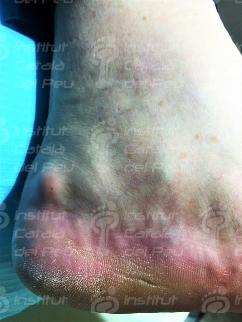 PIEZOGENIC PAPULES. GENERAL CONCEPTS.