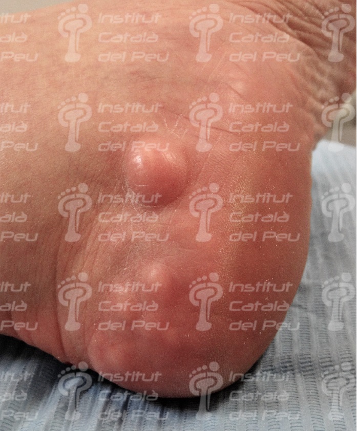 PIEZOGENIC PAPULES. GENERAL CONCEPTS. PIEZOGENIC PAPULES. GENERAL CONCEPTS.