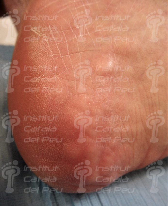 PIEZOGENIC PAPULES. GENERAL CONCEPTS.