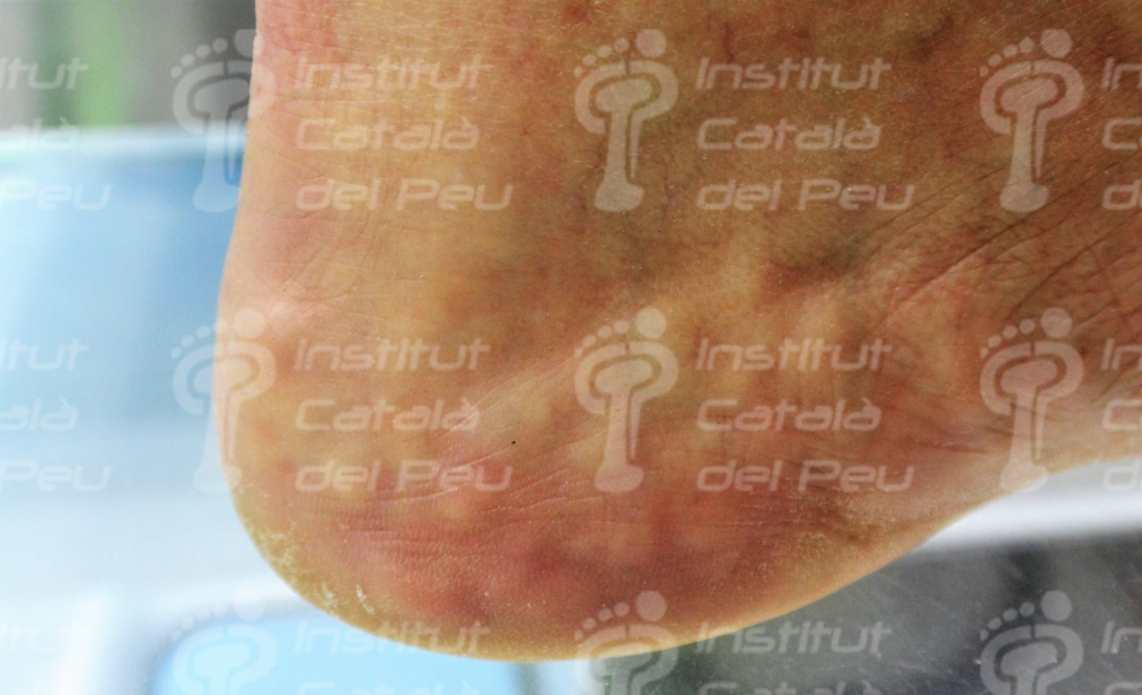 PIEZOGENIC PAPULES. GENERAL CONCEPTS. PIEZOGENIC PAPULES. GENERAL CONCEPTS.