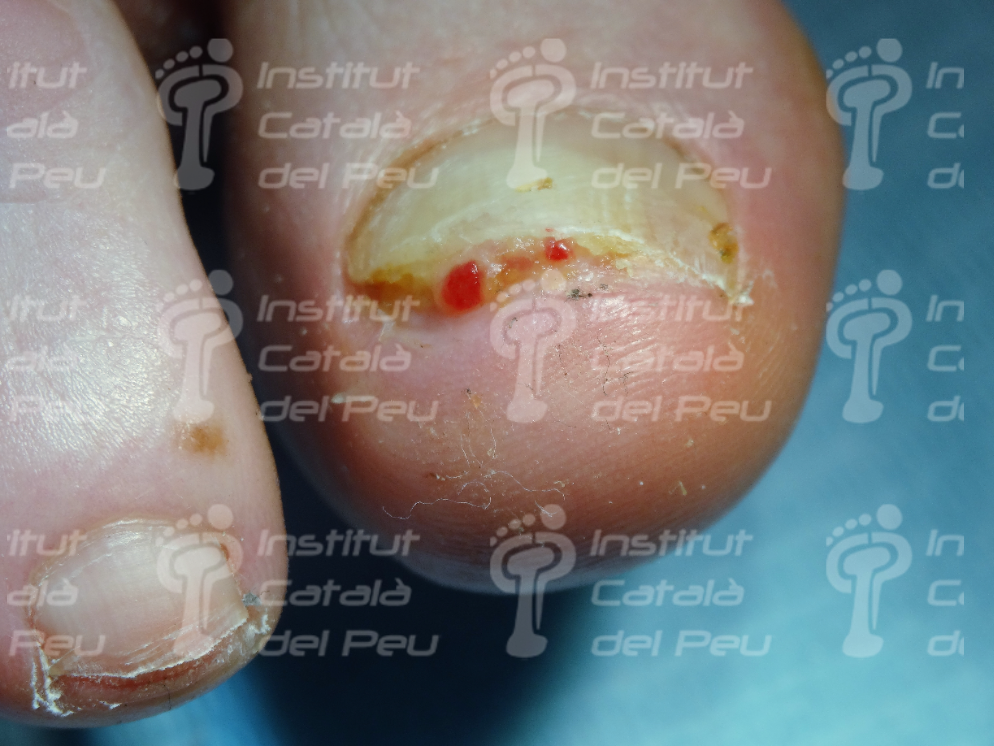 Subungual onychomycosis due to Aspergillus niger mimicking a glomus tumor:  A case report