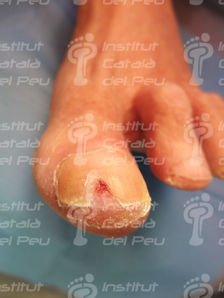 THE SUBUNGUAL HELOMA. APPEARANCE AND TREATMENT.