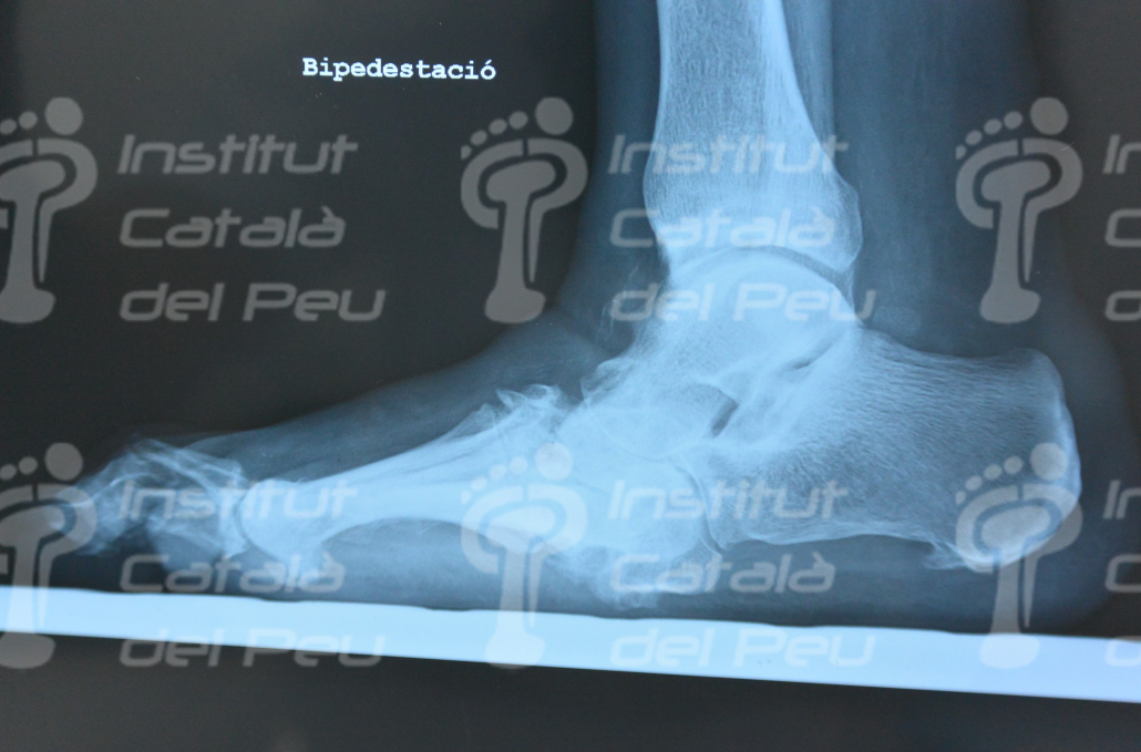 THE CHARCOT’S SYNDROME. APPEARANCE AND TREATMENT.