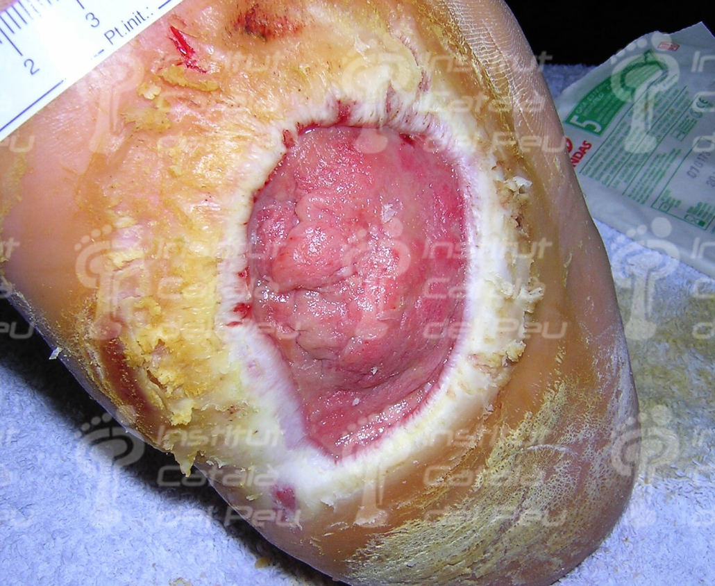 THE CHARCOT’S SYNDROME. APPEARANCE AND TREATMENT.