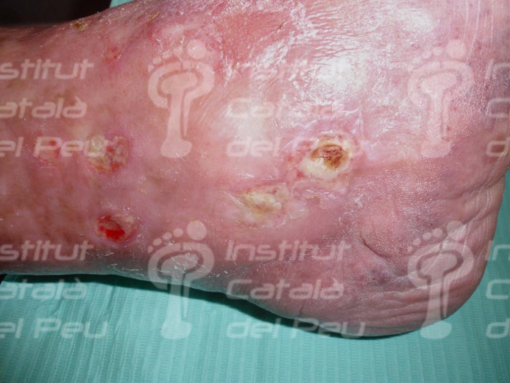 Úlceras de extremidades inferiores: clasificación