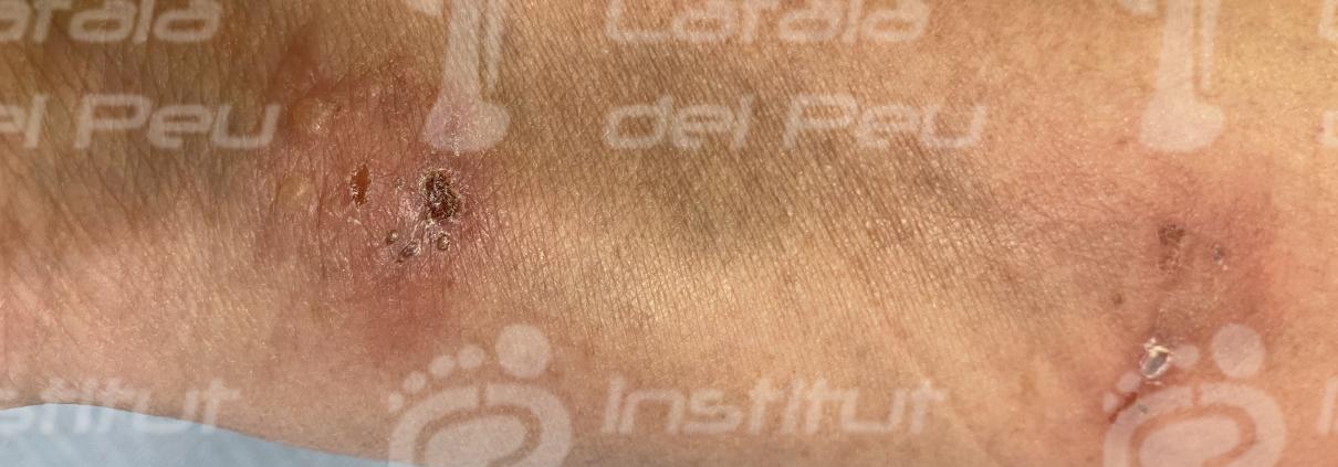 Dermatological Alterations